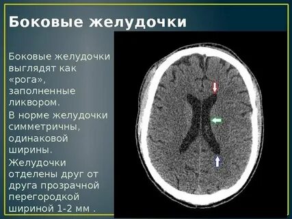 3 желудочек головного мозга размеры