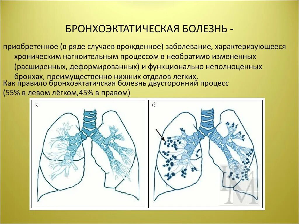 Бронхоэктатическая эмфизема. Бронхоэктатической расширение бронхов. Бронхоэктатическая пневмония. Хронический бронхит бронхоэктаз.