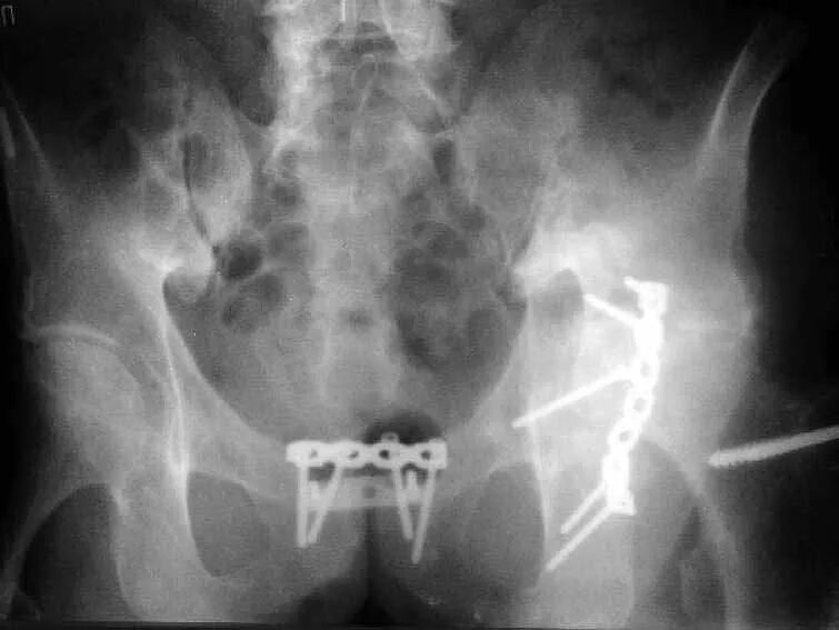 Остеосинтез лонного сочленения. Остеосинтез лобкового симфиза. Перелом лонного сочленения рентген. Остеосинтез костей таза.