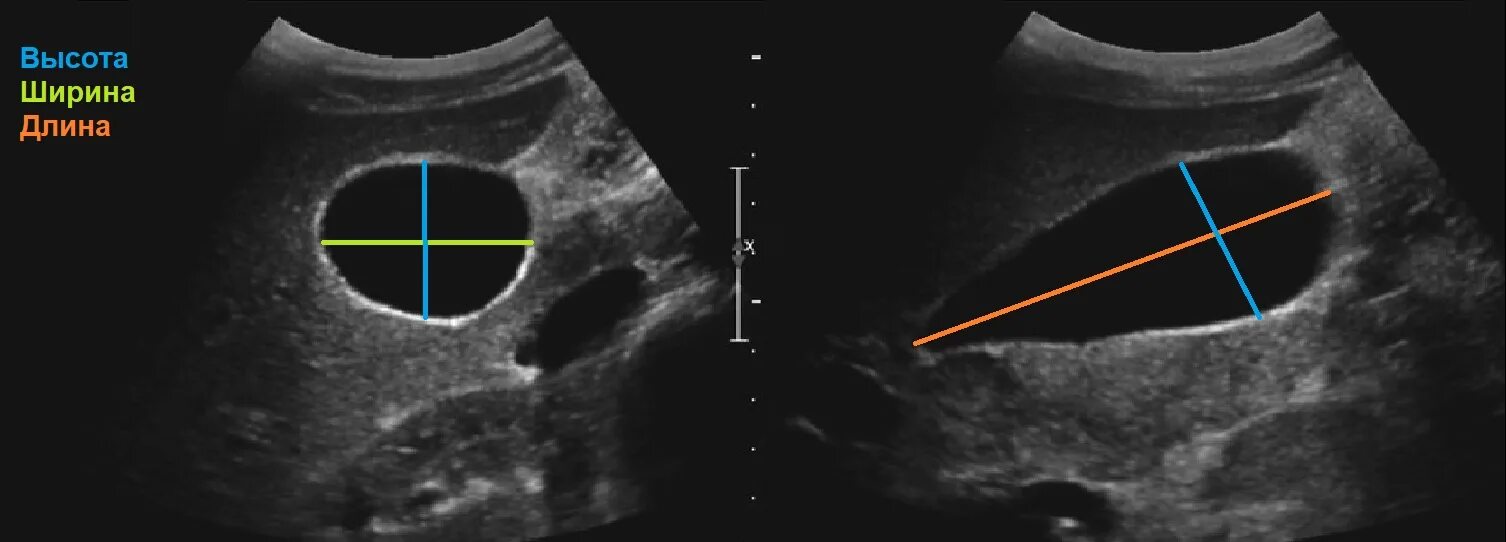 Диаметр желчного пузыря. Ультразвуковое исследование желчный пузырь норма. УЗИ желчного пузыря острый холецистит. Нормальный желчный пузырь на УЗИ. УЗИ нормального желчного пузыря снимок.