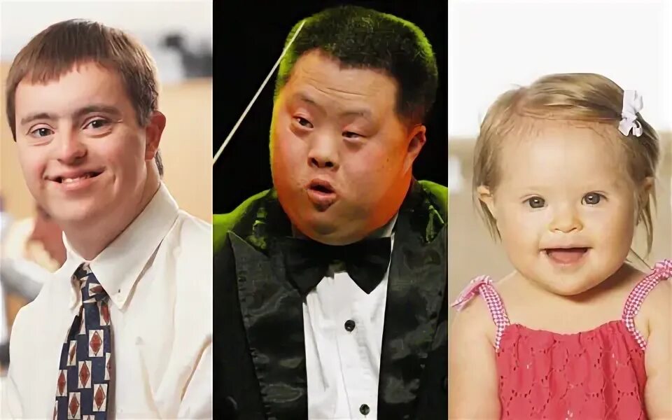 дауны внешность. почему дауны похожи. дауны похожи друг на друга. почему дауны похожи. лицо человека с синдромом дауна.