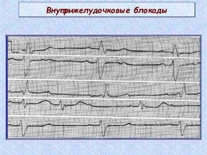 Блокада правого желудочка. Желудочковая блокада на ЭКГ. Внутрижелудочковые блокады на ЭКГ. Очаговая блокада на ЭКГ. Признаки внутрижелудочковой блокады на ЭКГ.