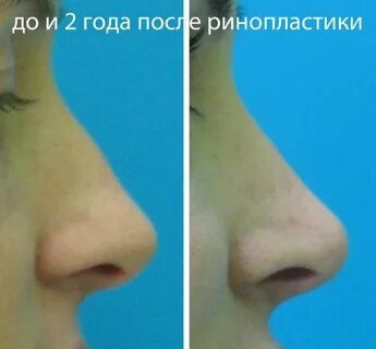 Ринопластика отек сколько