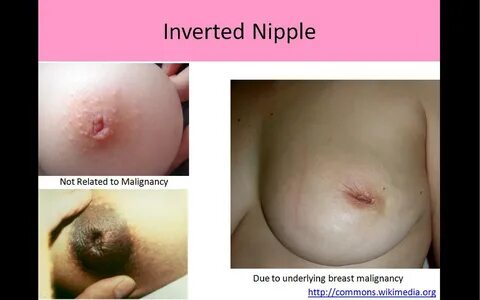 Slideshow budding breast pics.