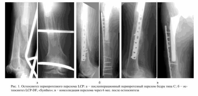 Накостный остеосинтез голени рентген. Перелом бедра остеосинтез. Перипротезный перелом остеосинтез. Экстрамедуллярный остеосинтез. Осложнения остеосинтеза