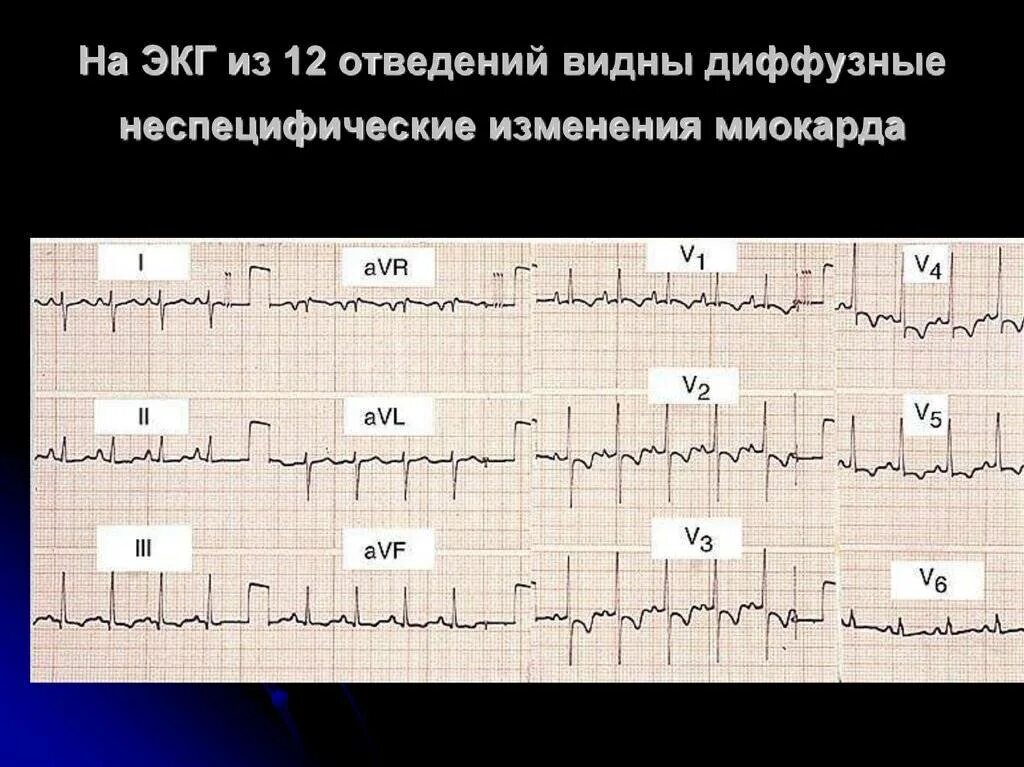 Умеренные метаболические изменения. Диффузное поражение миокарда ЭКГ. ЭКГ при метаболических изменениях миокарда. Диффузные неспецифические изменения миокарда на ЭКГ. Неспецифические изменения в миокарде на ЭКГ что это.