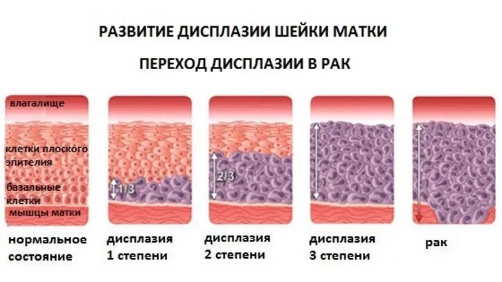 Изменение клеток матки. Дисплазия эпителия 3 степени. Дисплазия шейки 1 степени. Дисплазия 1-2 степени шейки.