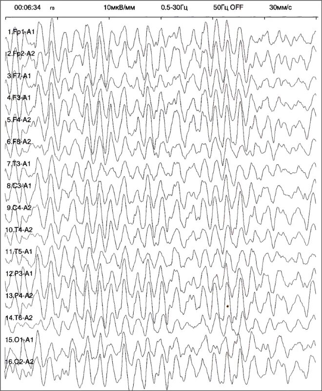 Сколько длится ээг. Рисунок нормальных показателей ЭЭГ. Усилитель Nicone ЭЭГ. ЭЭГ диаграмма. Энцефалограмма и её показатели.