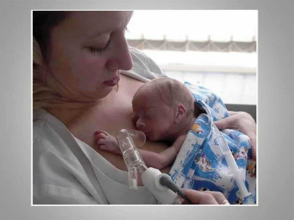 Вскармливание недоношенных новорожденных. Метод кенгуру для недоношенных. Недоношенность сепсис. Вскармливание недоношенных