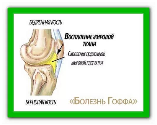 Клетчатка коленного сустава. Тело гоффа коленного сустава. жировое тело коленного сустава анатомия. клетчатка жирового тела гоффа. синдром жирового тела гоффа.