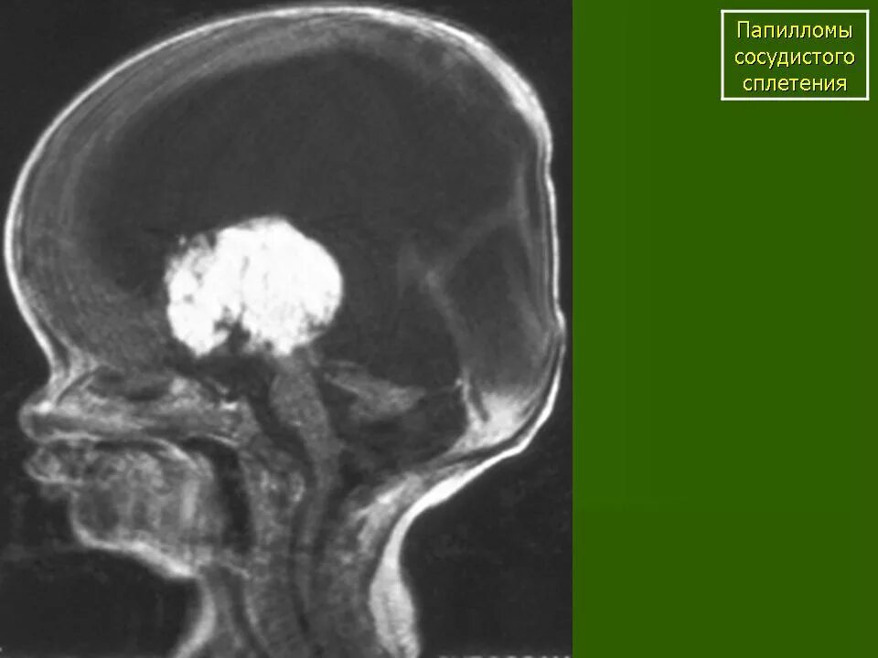 У плода киста мозга сплетения. Папилломы сосудистого сплетения кт. Хориоидная папиллома кт. Папиллома хориоидного сплетения кт. Киста сосудистого сплетения головного мозга кт.