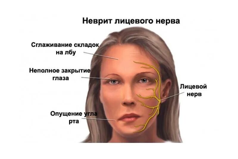 Воспаление тройничного лицевого симптомы. Неврит лицевого нерва центральный паралич. невропатия лицевого нерва. невропатия (неврит) лицевого нерва.. воспаление лицевого нерва.