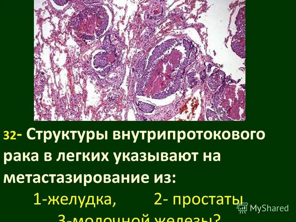 Рак простаты метастазы легких