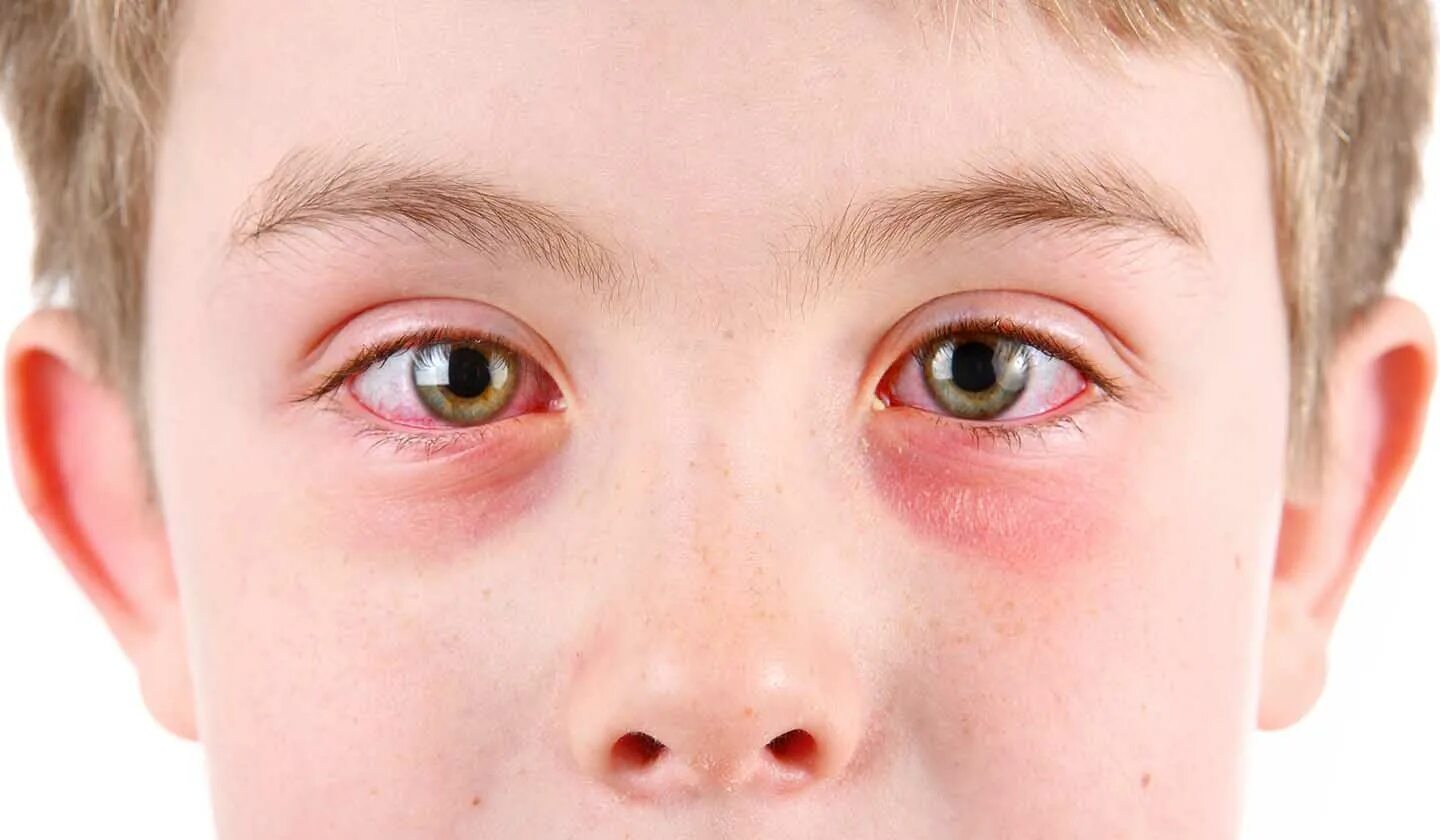 Конъюнктивит ребенка 7 лет. Поллинозный конъюнктивит. Аллергический конъюнктивит. Красные глаза конъюнктивит.