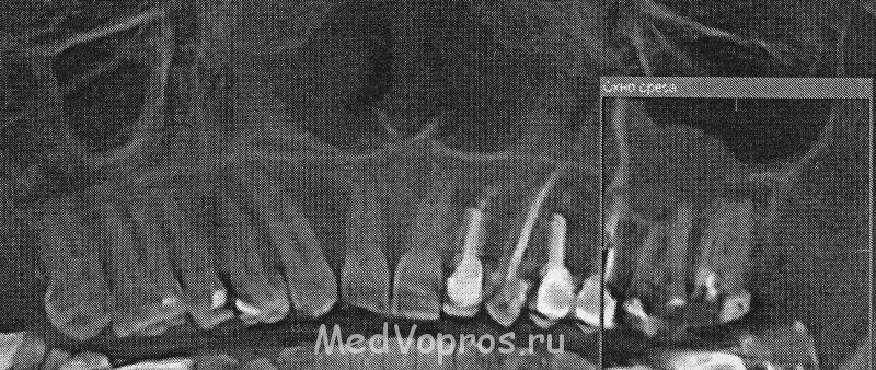 Неравномерное утолщение слизистой оболочки. Подушкообразное утолщение слизистой верхнечелюстной. Полиповидное утолщение слизистой верхнечелюстной пазухи. Пристеночное утолщение слизистой в пазухе рентген.