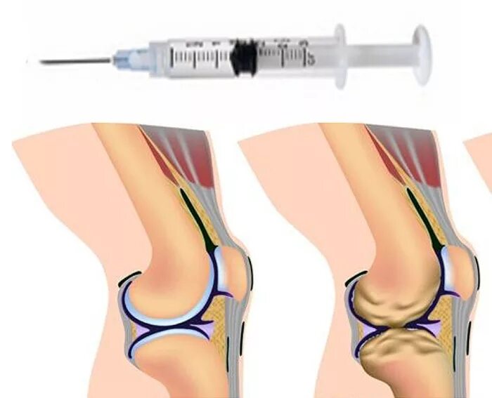 Что колят в суставы. Флексотрон смарт укол в сустав. Техника внутрисуставной инъекции в коленный сустав. Внутрисуставное Введение гиалуроновой кислоты в коленный сустав. Внутрисуставные блокады коленного сустава.