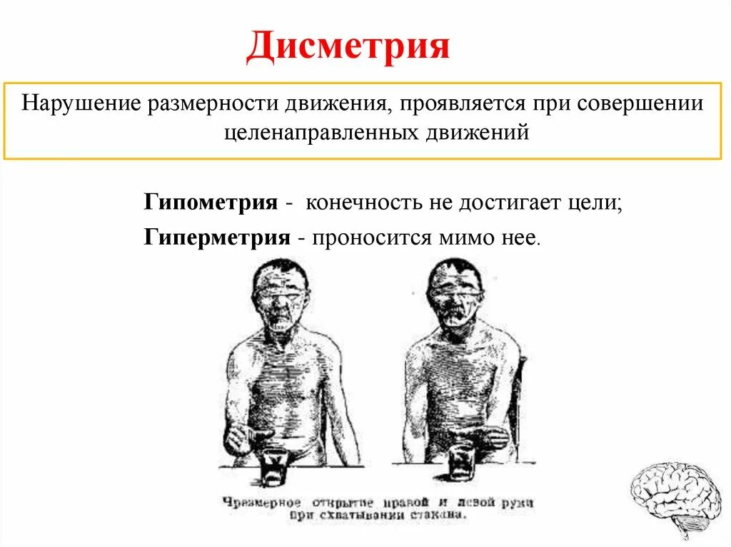 Тест мозжечок. Дисметрия и гиперметрия. Дисметрия это физиология. Дисметрия это в неврологии. Дисметрия мозжечка.