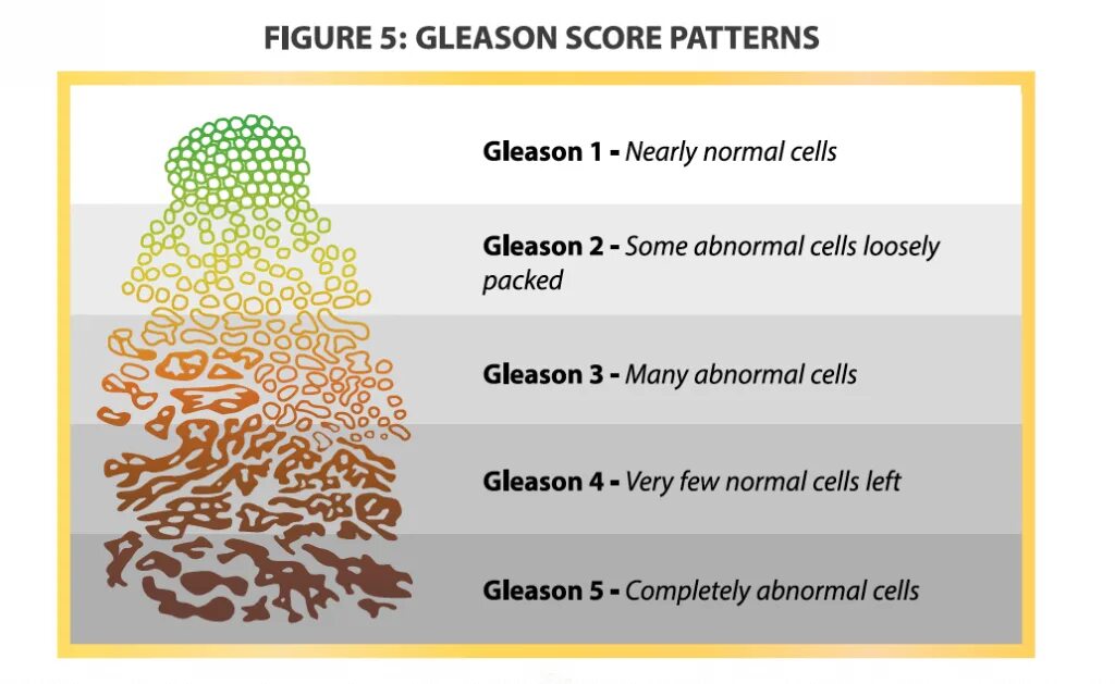Глисон простата. Gleason score. Gleason Grade. Глисон градация. Классификация по Gleason.