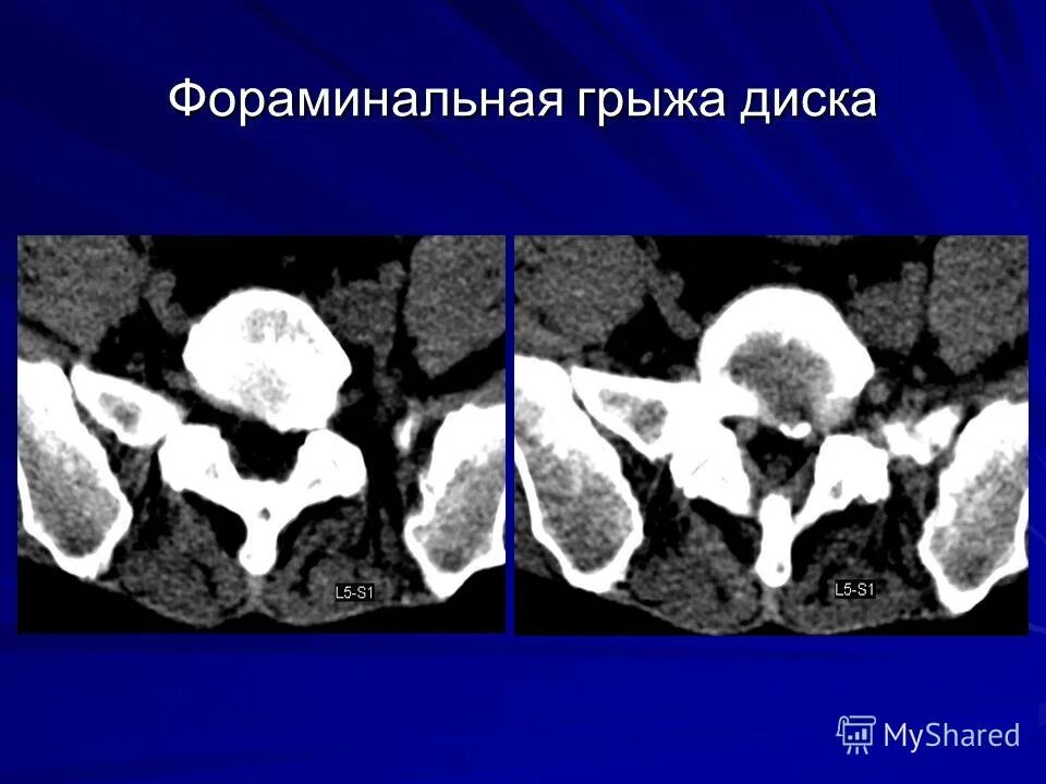 Фораминальная грыжа l5-s1. Экструзия дурального мешка l4. Левосторонняя парамедианно-фораминальная грыжа диска. Эпидурит протрузия. Фораминальная грыжа диска кт.