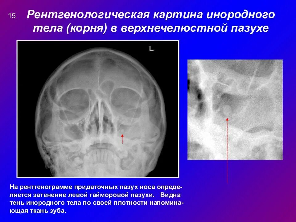 Содержимое в основной пазухе