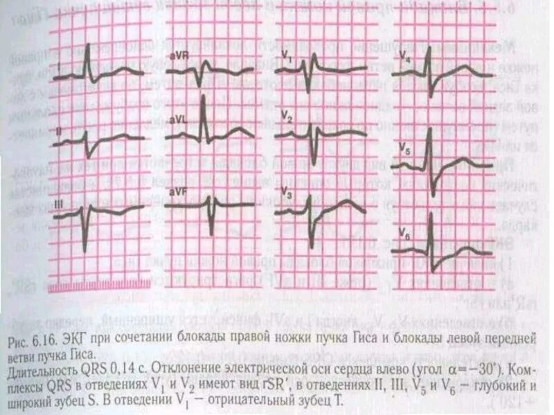 Блокада правого желудочка. ЭКГ гипертрофия правого желудочка и блокада правой ножки пучка Гиса. Блокада правого предсердия на ЭКГ. Полная блокада левой ножки пучка Гиса на ЭКГ. Гипертрофия левой ножки на ЭКГ.