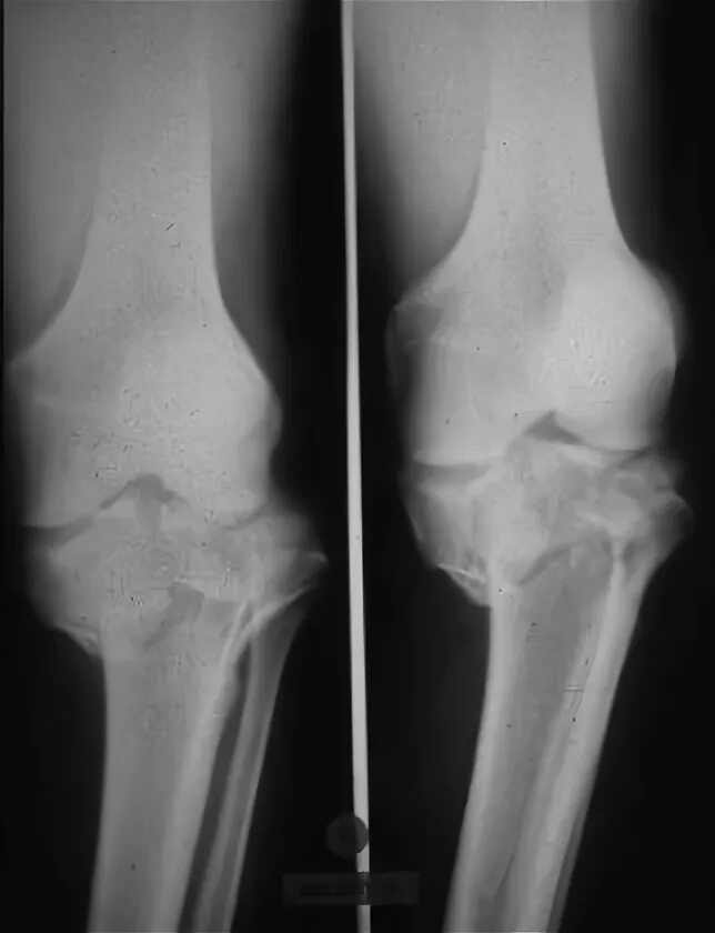 Внутрисуставной перелом мыщелков большеберцовой кости. Гипоплазия большеберцовой кости. Перелом надколенника остеосинтез. Остеосинтез мыщелка большеберцовой кости. Остеосинтез мыщелка