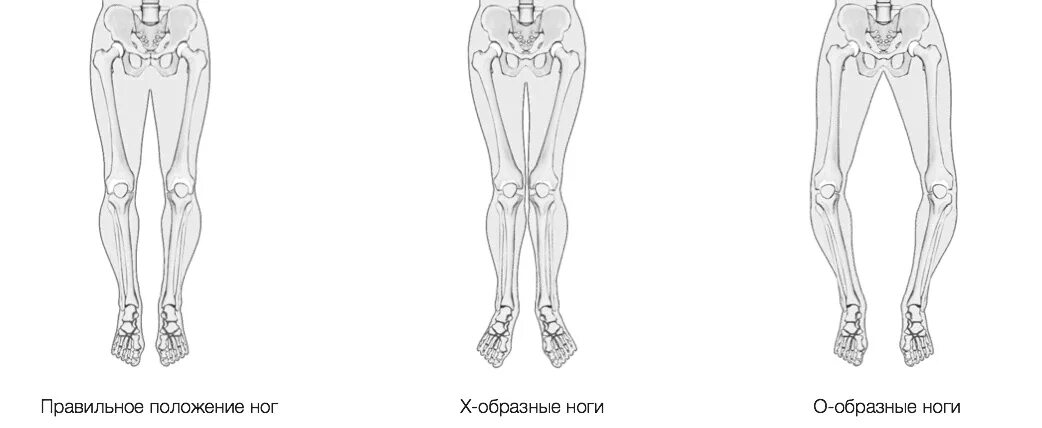 Почему ноги колесом. Вальгусная деформация х образные ноги. Варусная деформация коленных суставов. Варусная деформация ног у взрослых. Кривые ноги х-образные.