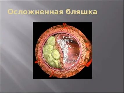 Бляшка это