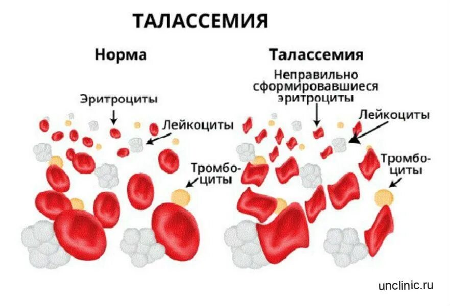 Анемия наследуется. Гемолитическая анемия талассемия. талассемия форма эритроцитов. бета талассемия анемия. талассемия классификация.