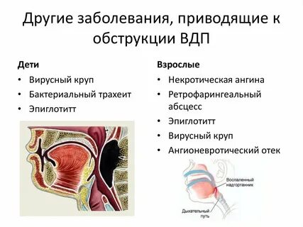 Обструкция это простыми словами