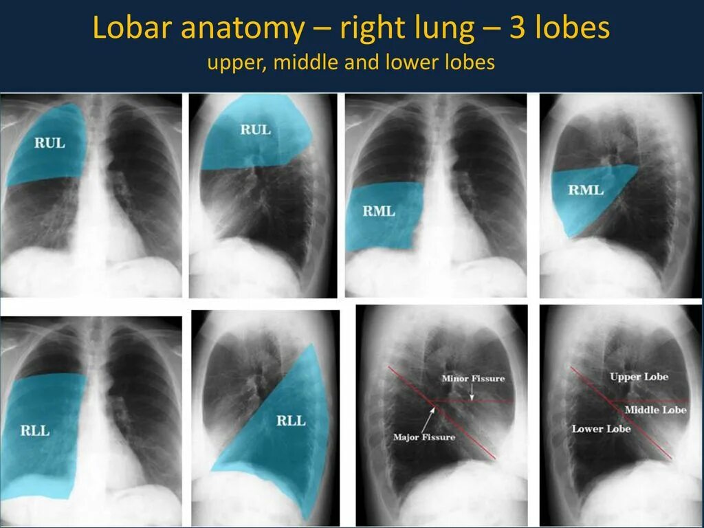 Сегмент s4 правого легкого. Доли легкого на рентгенограмме. Лоди легкого на рентгене. Доли правого легкого на рентгене. S8 левого легкого