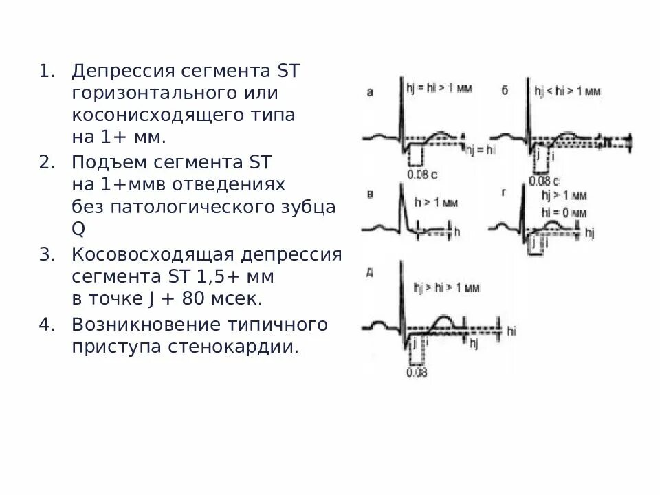 Сегмент смещение что это. Горизонтальная депрессия сегмента st на экг. корытообразная депрессия сегмента st на экг. депрессия сегмента st на экг в 1 отведении. депрессия сегмента st на экг типична для.