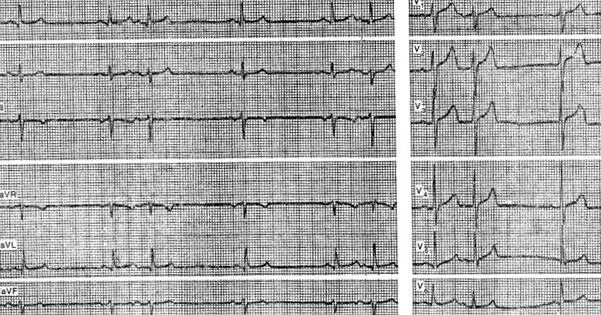 Ишемия миокарда на экг. Ритм при стенокардии. Изменения экг при стабильной стенокардии. Экг при ибс стенокардии 3 функционального класса. Экг признаки ибс и стенокардии.