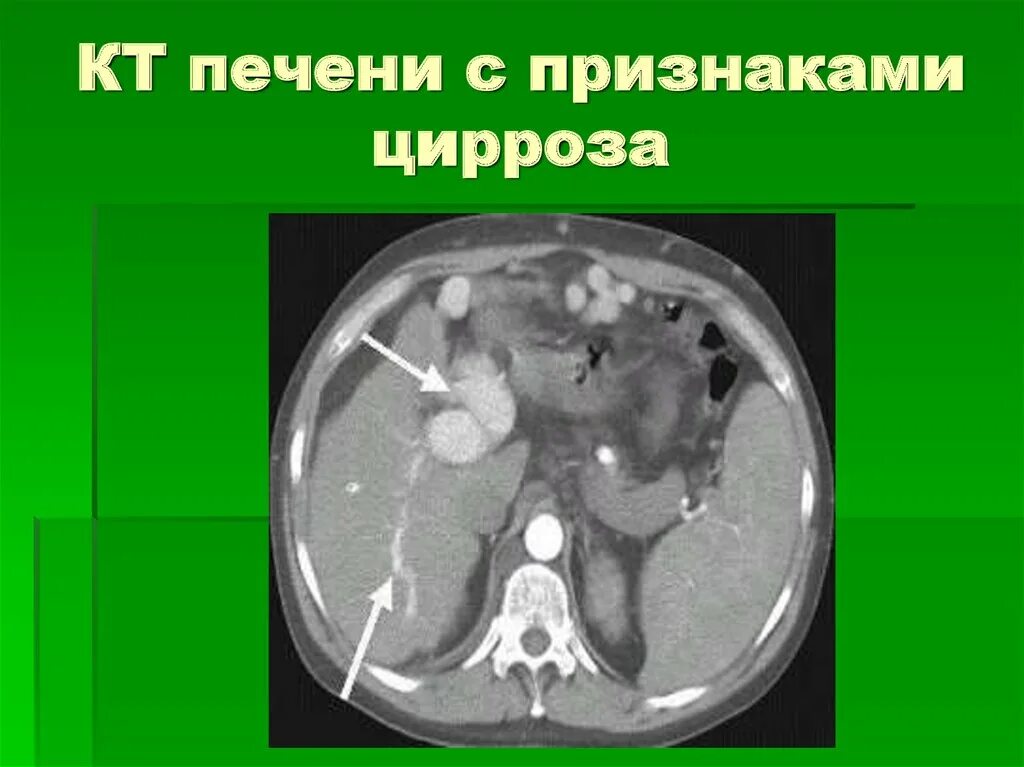 Цирроз на кт. Компьютерная томография кт цирроз печени. цирротическая трансформация печени кт. крупноузловой цирроз печени на кт. цирроз печени на кт с контрастом.