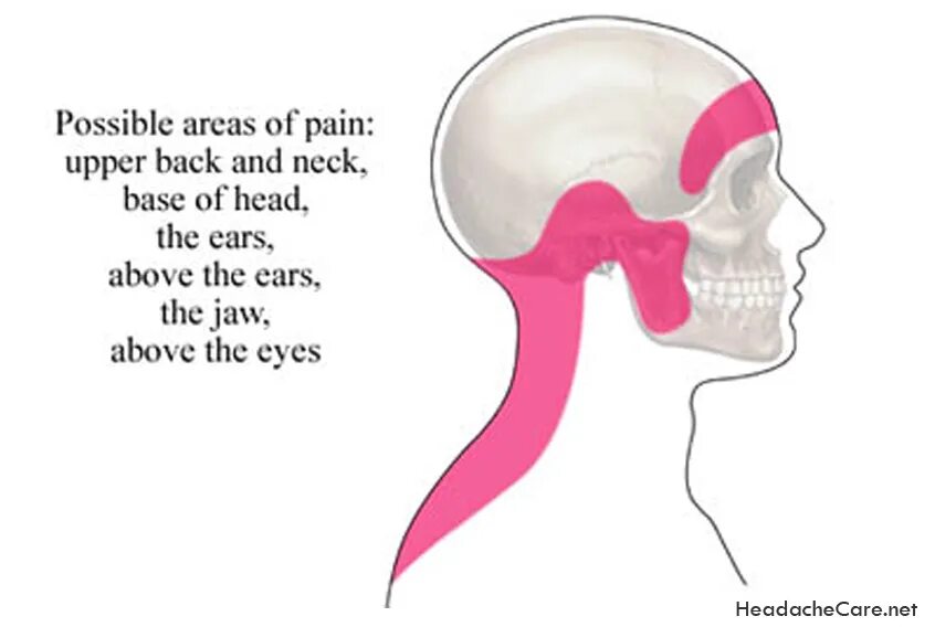 A pain in the neck. To be a pain in the neck идиома. A pain in the neck. Tension headache. Pain in the neck idiom.