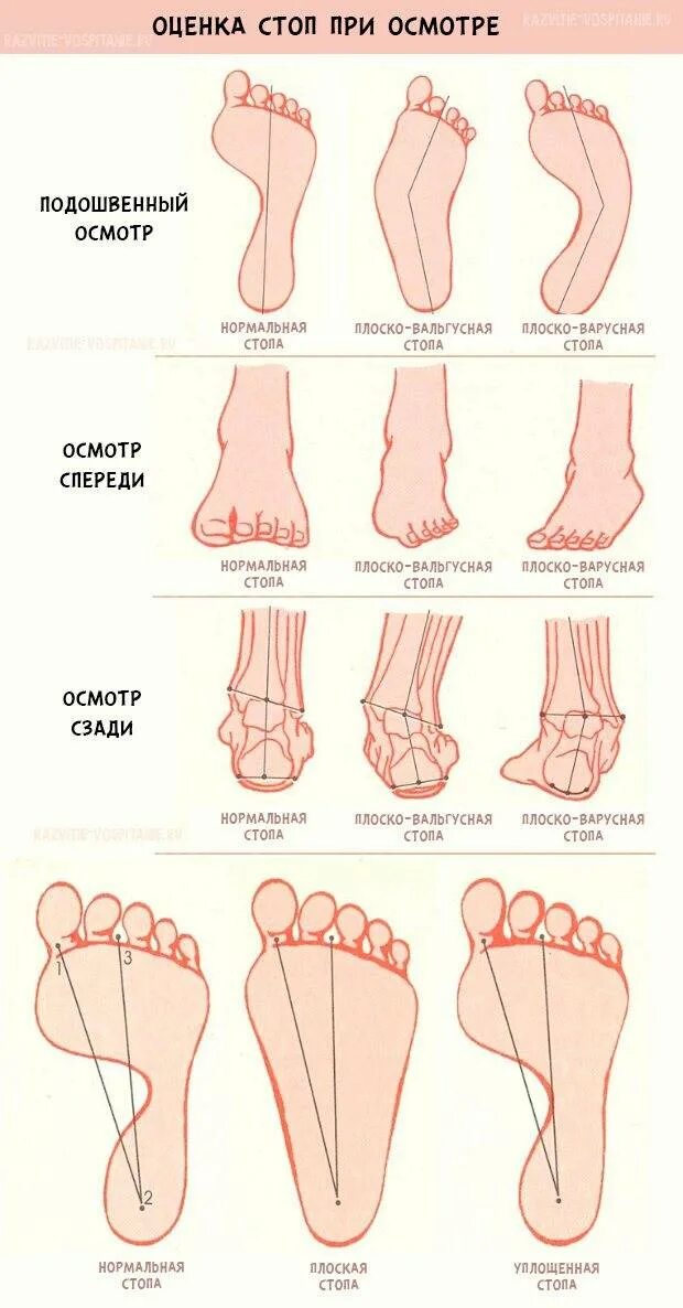 За сколько вырастает нога за год. Вальгусная и варусная деформация стопы. Вальгусная деформация 1п стопы. Плоско-вальгусная деформация стопы плоскостопие 2 степени. Плоскостопие варусная.