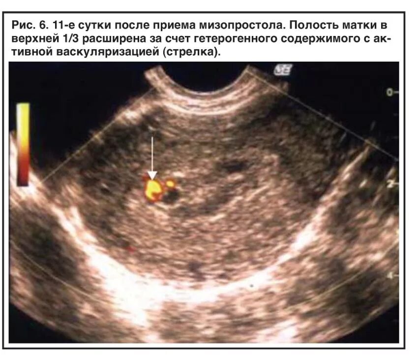 Беременность после вакуум аспирации замершей беременности. Плодное яйцо 5 недель медикаментозное прерывание. Замершая беременность УЗИ. Неполный медикаментозный аборт. УЗИ после медикаментозного аборта.