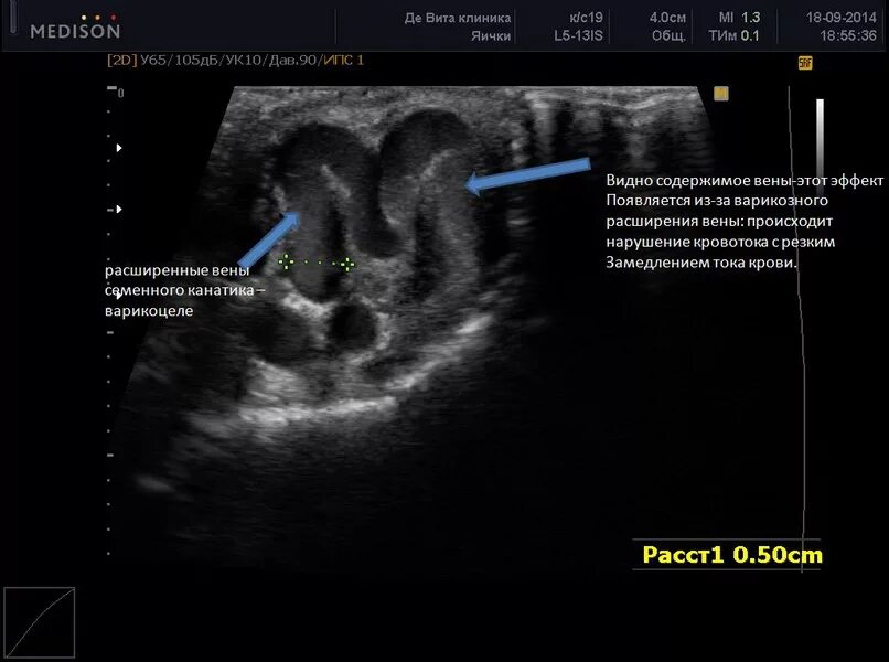 Варикозное расширение вен семенного канатика на УЗИ. Варикоцеле-расширение вен семенного канатика яичка. Варикоцеле 3 степени заключение УЗИ. Семенной канатик на УЗИ норма. Вена левого яичка