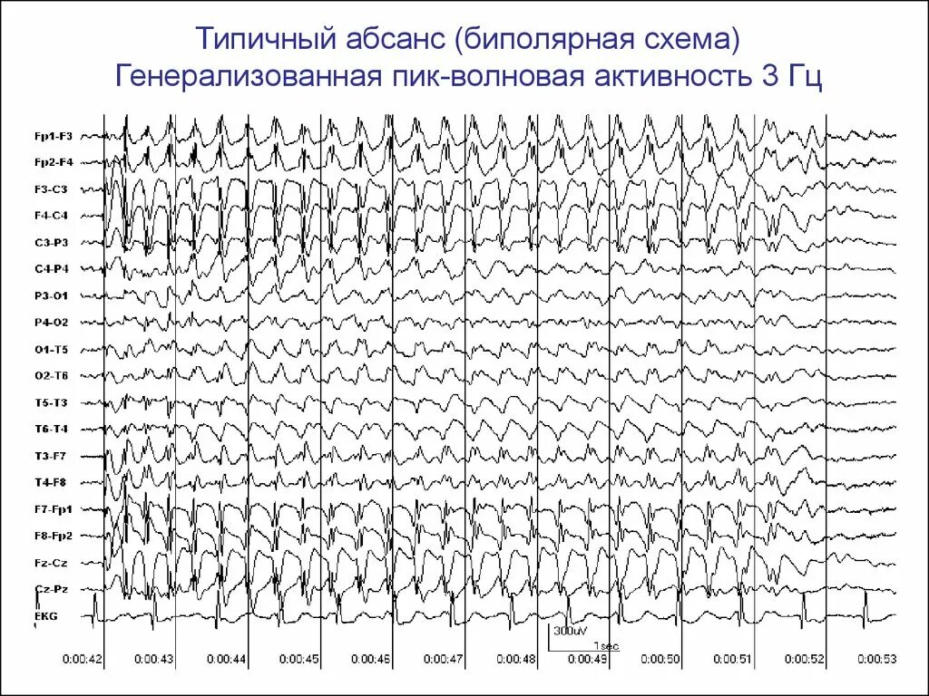 Детская абсансная эпилепсия. Абсансная эпилепсия на ЭЭГ. Паттерн абсанса на ЭЭГ. Генерализованная эпилептиформная активность на ЭЭГ У ребенка. Детская абсансная эпилепсия на ЭЭГ.
