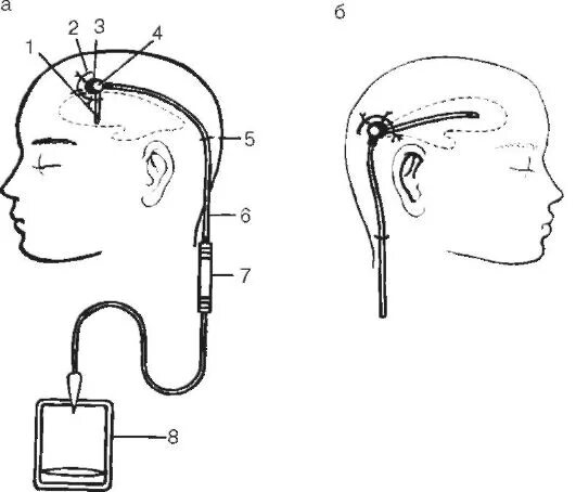 Шунт головного мозга. Наружное дренирование желудочков головного мозга. Дренирование желудочков мозга. Наружное вентрикулярное дренирование. Гидроцефалия наружный дренаж вентрикулярный.