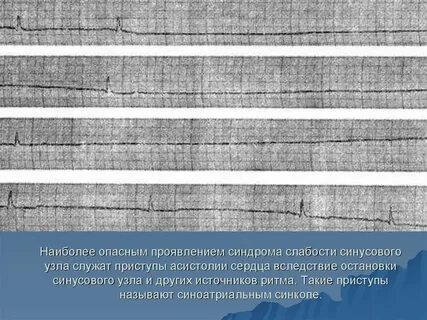 Синдром синусового узла лечение