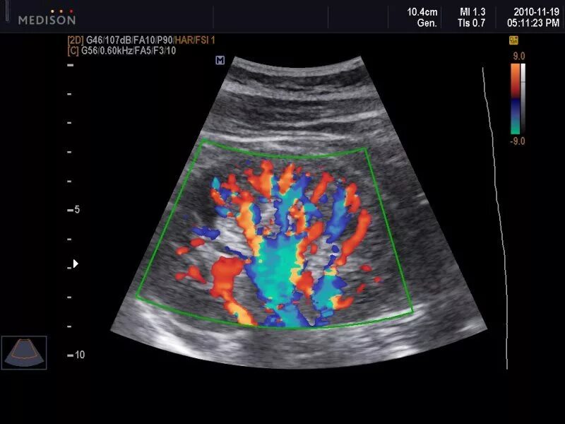 Доплер кровотоки. Допплерография сосудов при беременности. Допплеровская сонография. Ультразвуковая допплерография сосудов почек. УЗИ С доплером при беременности.