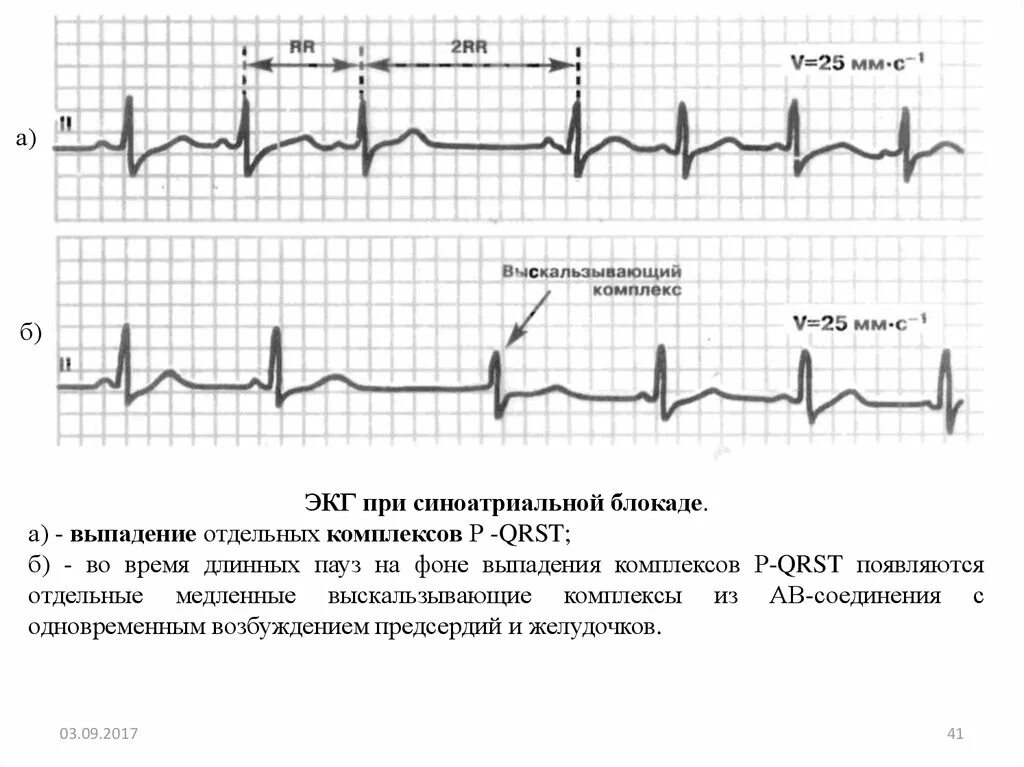 Комплекс блокада. ЭКГ при синоатриальной блокаде. Выскальзывающие комплексы на ЭКГ из предсердия. Выскальзывающие комплексы из АВ соединения на ЭКГ. Выскальзывающие желудочковые комплексы на ЭКГ.