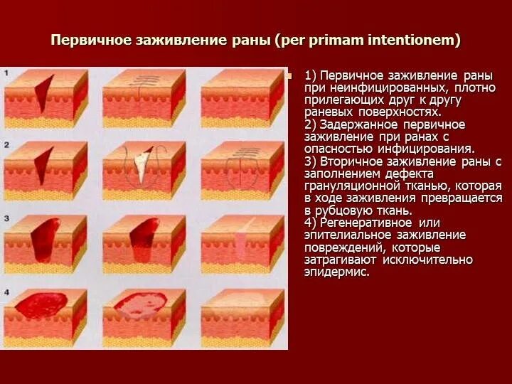 Сильная рана что делать. Стадии заживления резаной раны. Морфология первичного заживления РАН. Этапы вторичного заживления РАН. Этапы заживления РАН вторичным натяжением.