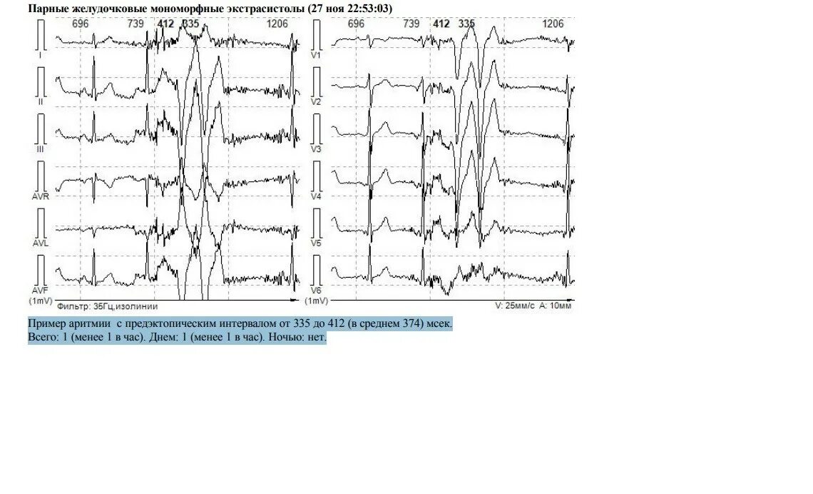 Мономорфная желудочковая экстрасистолия. Политопные желудочковые экстрасистолы на экг. Мономорфная желудочковая экстрасистолия. Мономорфная желудочковая экстрасистолия. Политопная экстрасистолия на экг.