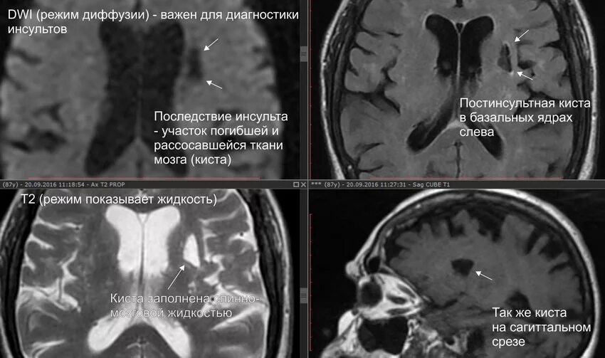 Лакунарная ишемия головного мозга. Кисты базальных ядер головы на кт. Постинсультные кисты в головном мозге. Лакунарная киста левой гемисферы головного мозга. Ликворные кисты в базальных ядрах.