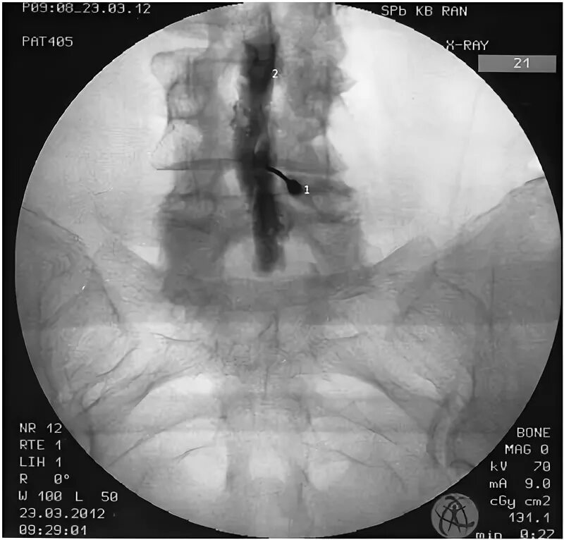Фасеточная блокада. Блокада фасеточных суставов под контролем рентгена. Фасеточный синдром блокада. Блокада эпидуральная под рентгенологическим контролем. Блокады фасеточных суставов под рентгеном.
