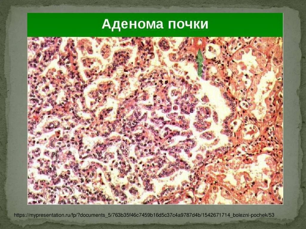 Светлоклеточная аденома почки гистология. Липецк аденома. Плеоморфная аденома околоушной гистология. Аденома почки макропрепарат. Гюртлеклеточная аденома щитовидной железы.