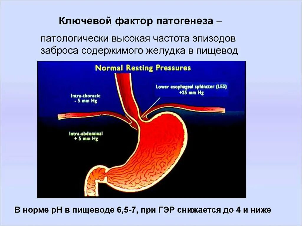 Заброс кислоты в пищевод