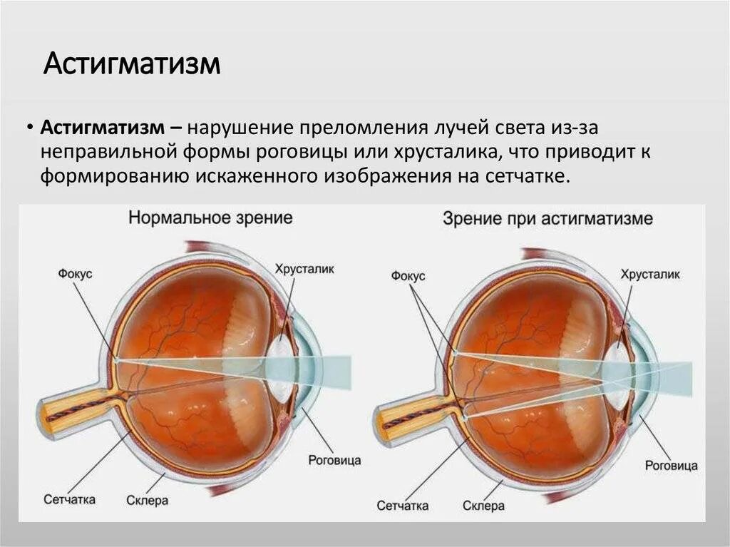 Зрение 2.5 астигматизм. Астигматическое нарушение зрения. Астигматизм схема. Строение глаза астигматизм.